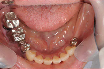 奥歯のインプラント治療